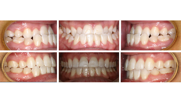 Invisalign® Before & After, Orthodontist San Carlos Menlo Park