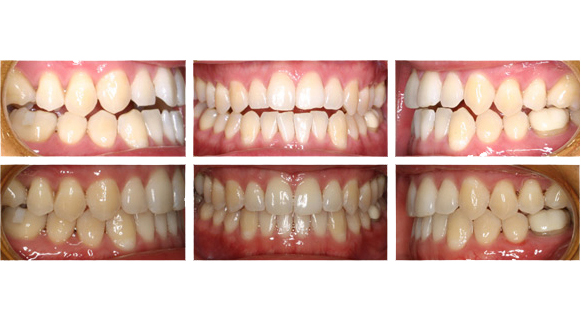 Invisalign® Before & After, Orthodontist San Carlos Menlo Park